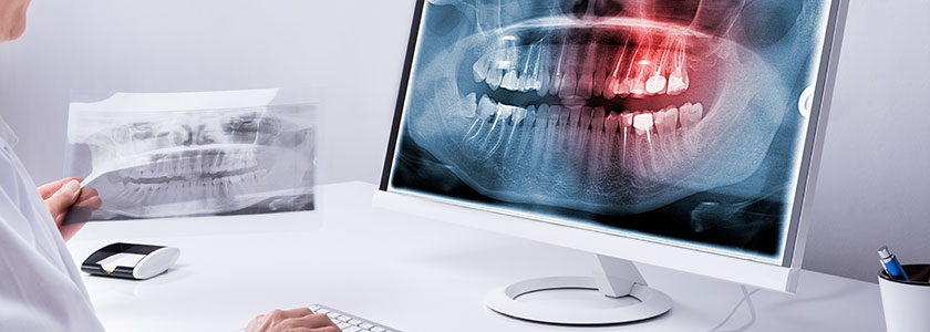 Digital X-Rays | Today's Dental